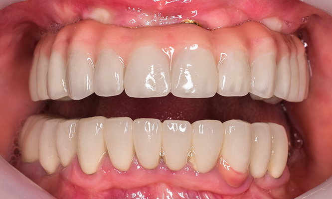 Implant supported denture after