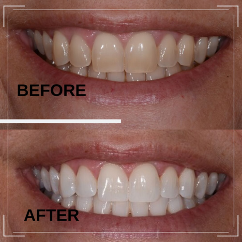 How much does dental teeth whitening cost