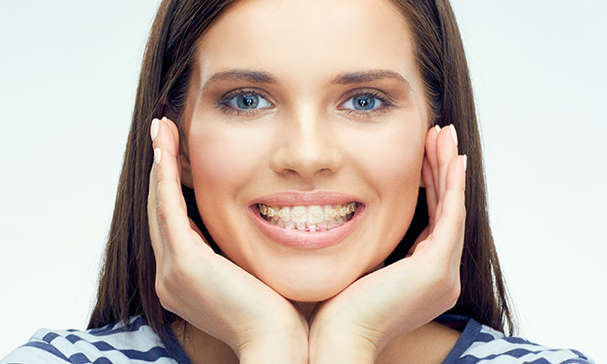 Examples of Six Month Smiles braces